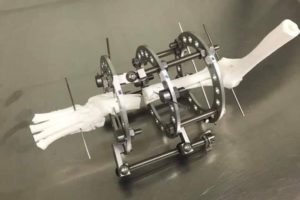 orthopedic surgeon Jason Bleedorn used bone models to rehearse various correction options for Jem’s deformity