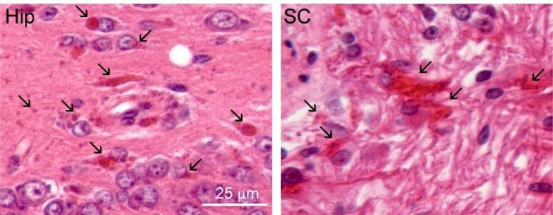 A hallmark of Alexander disease is the buildup of abnormal proteins called Rosenthal fibers, pictured here (red) in brain tissue from a study of a rat model of the disease.