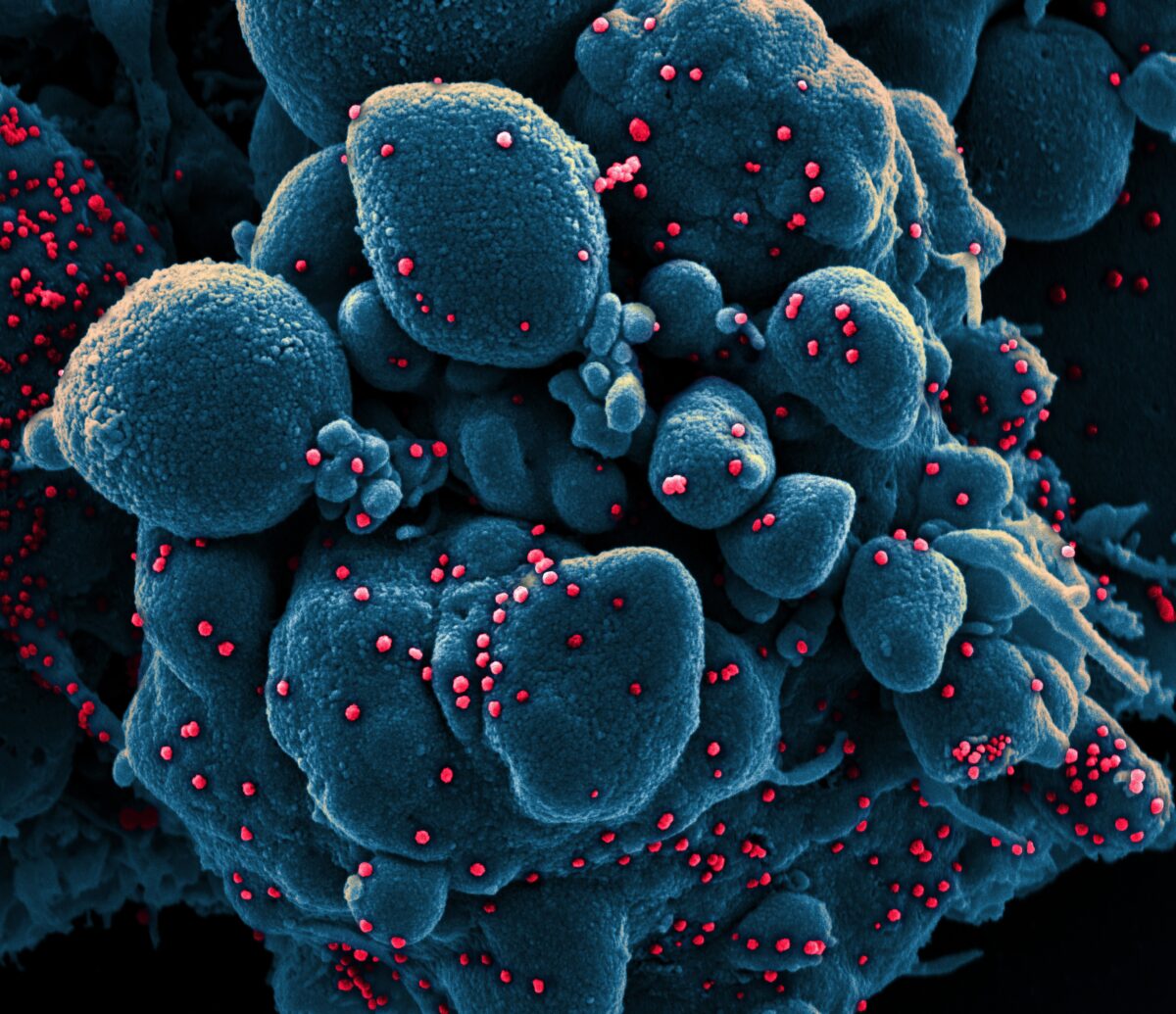 Colorized scanning electron micrograph of an apoptotic cell (blue) infected with SARS-COV-2 virus particles (red), isolated from a patient sample. Image captured at the NIAID Integrated Research Facility (IRF) in Fort Detrick, Maryland. Credit: National Institute of Allergy and Infectious Diseases, NIH