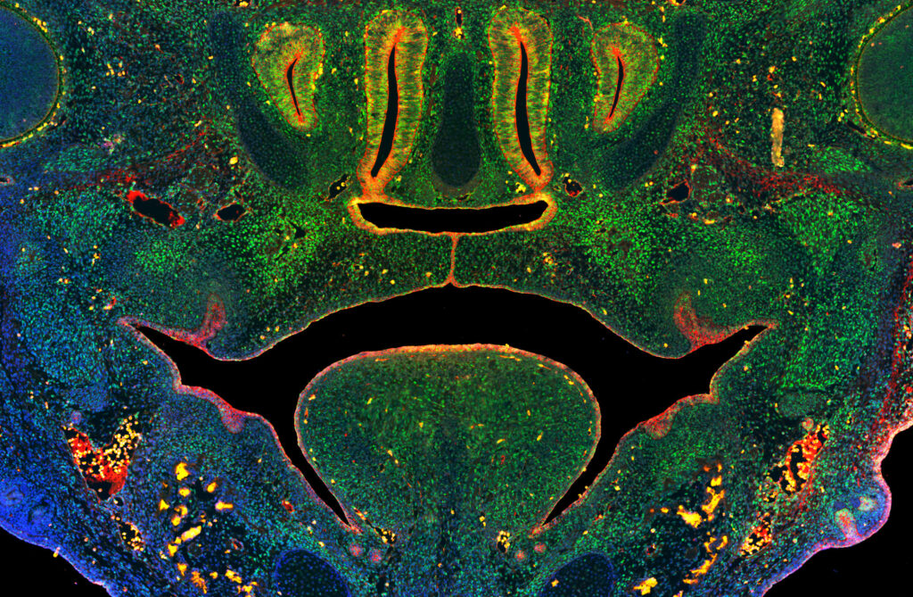 UW researchers uncover new clues about the cause of common birth ...